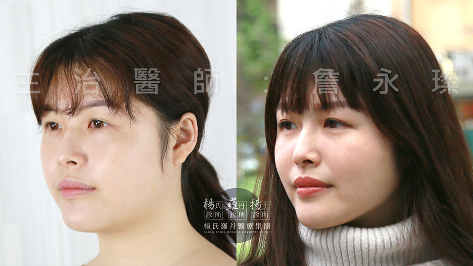 雷射減脂 瘦臉 瘦下巴  減脂手術 